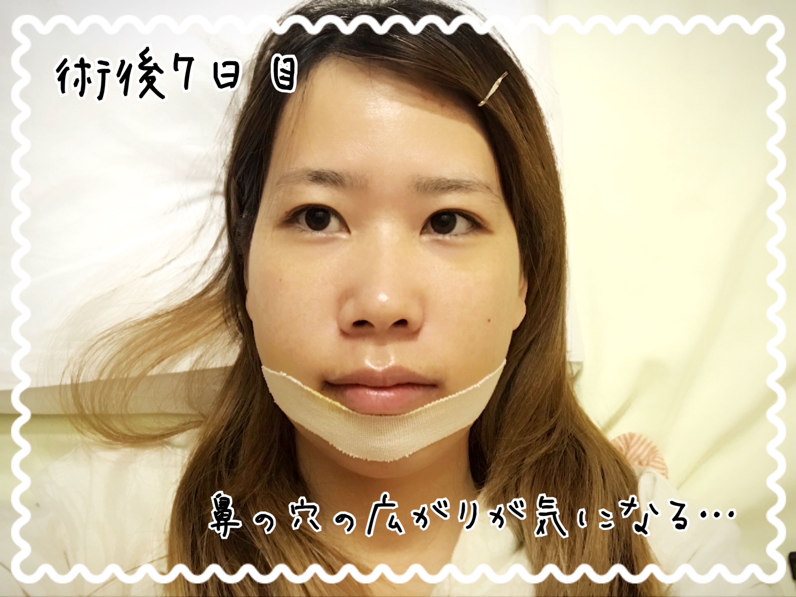 顎変形症手術　顔の腫れ